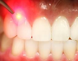 Лазерная стоматология в городе Киев